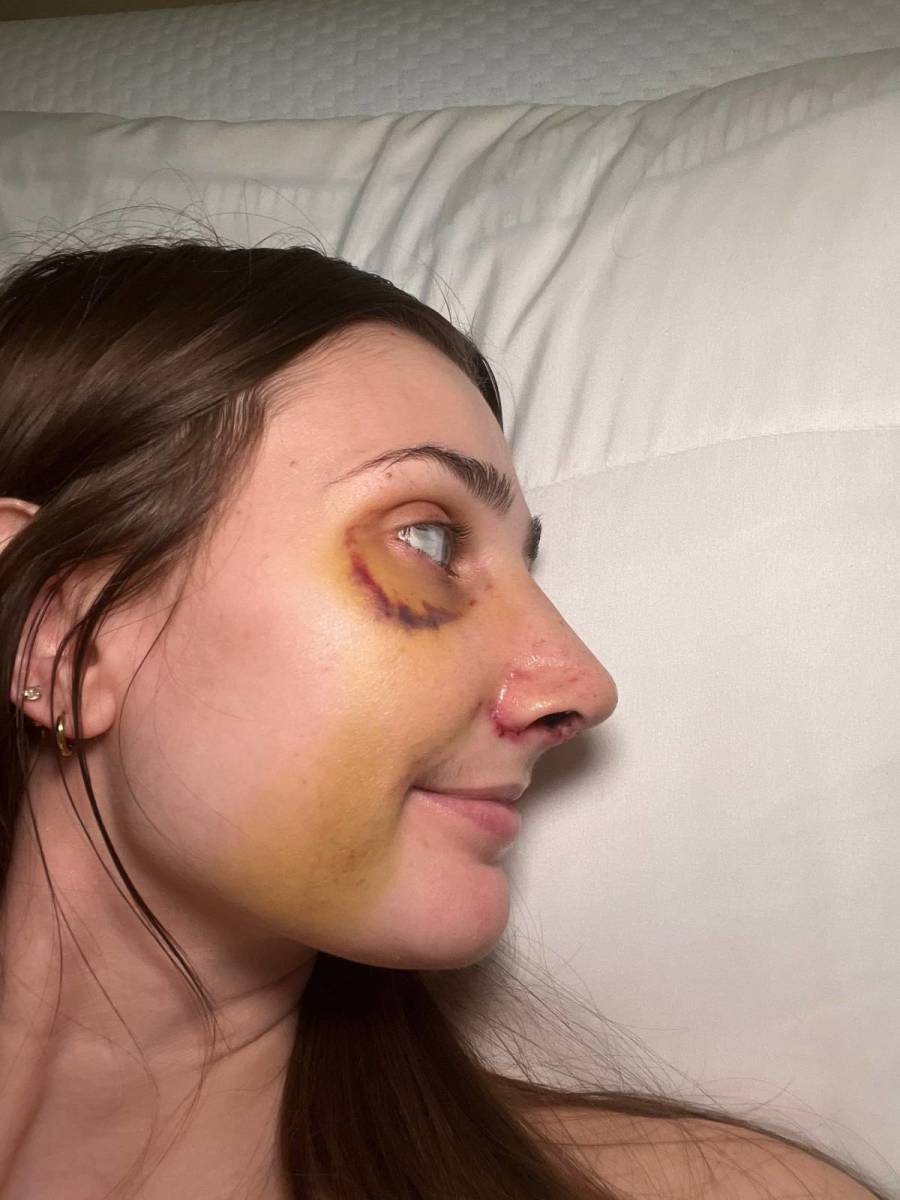 Devyn Aiken several days after her nose surgery, Photo Credit: doseofdevy/Tiktok