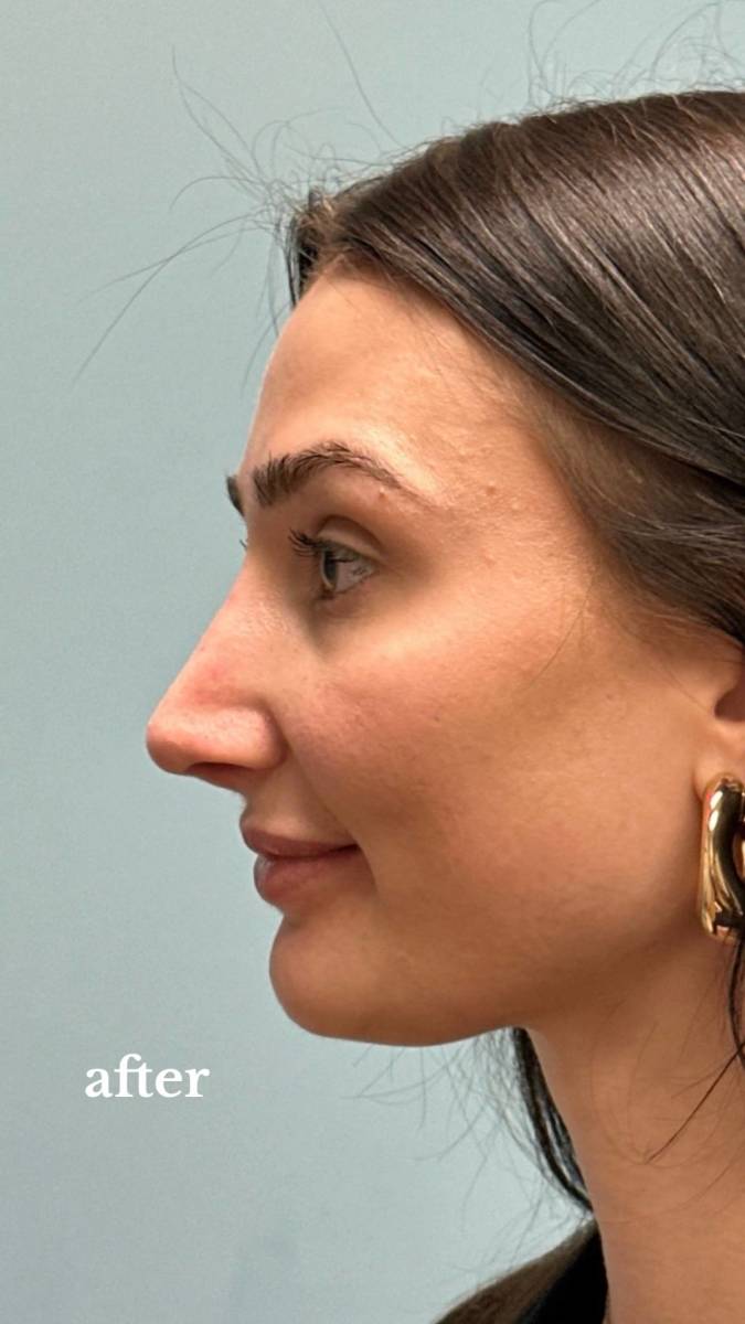 Devyn Aiken healed after her nose surgery, Photo Credit: doseofdevy/Tiktok