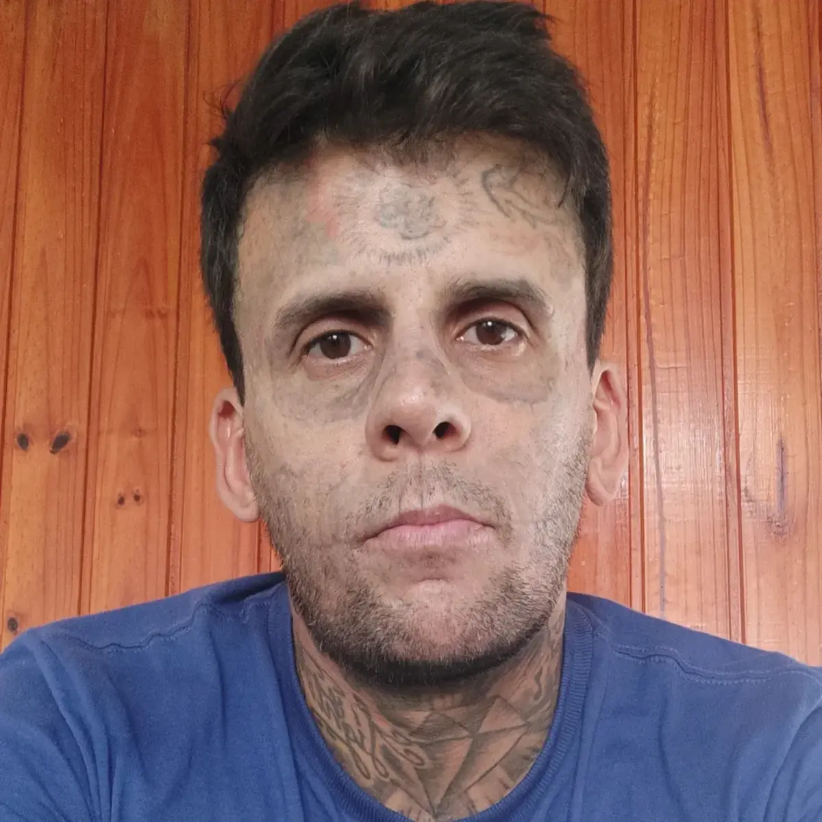 Leandro de Souza's face 8 days after his fourth laser treatment session, Photo Credit: leandrodesouzabless/Instagram