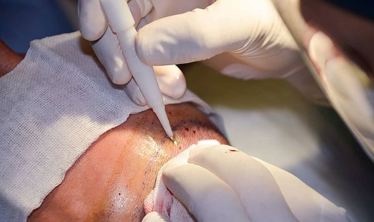 Closeup of a surgeon giving a patient a hair transplant to their scalp, Photo Credit: wikimedia